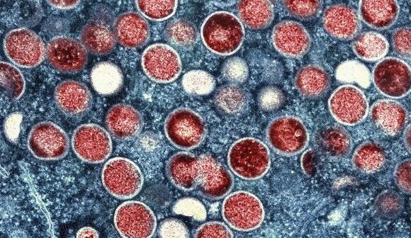 Suécia Confirma Primeiro Caso de mpox