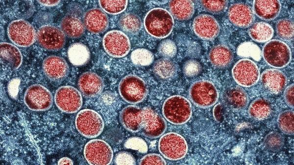 @ Suécia Confirma Primeiro Caso de mpox Suécia Confirma Primeiro Caso de mpox